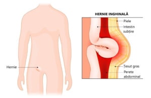 Hernii Inghinale