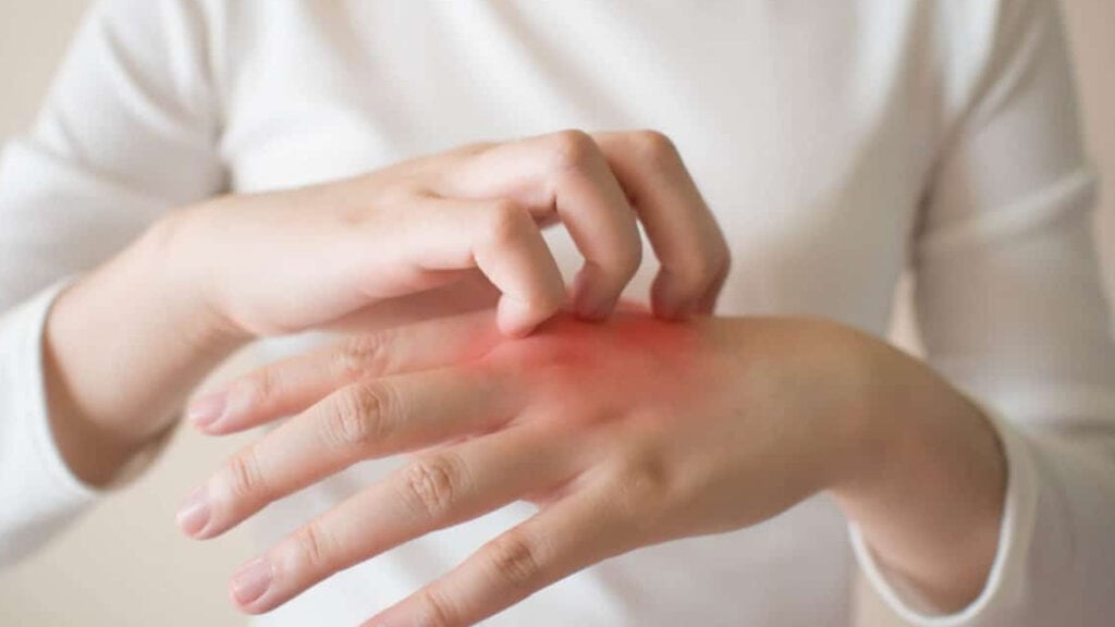 Eczema Mâinilor