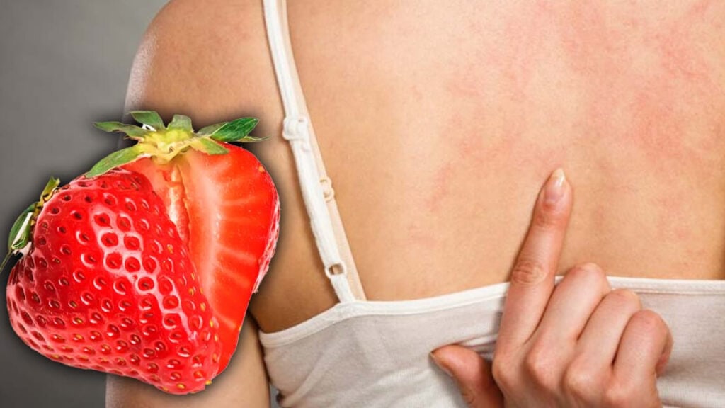 Alergia la căpșuni